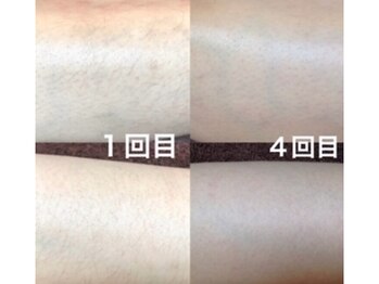 リッカロッカ(RIKKA&ROCCA)/数回でここまで変わる