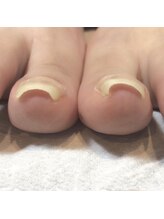 ヌナ(NEUNA)/巻き爪ケア