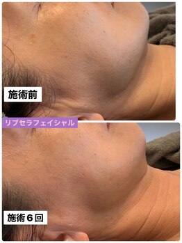 プリュネル(Prunelle)/プラズマシャワー