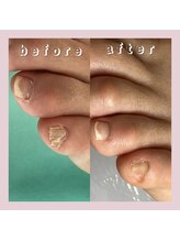 巻き爪補正店 大阪なんば店/副爪1箇所