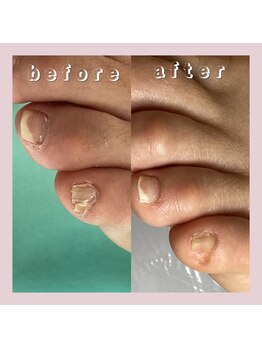 巻き爪補正店 大阪なんば店/副爪1箇所