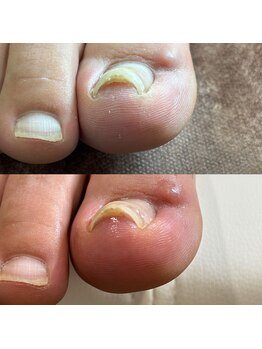 リリ(lili)/巻き爪矯正/4回目