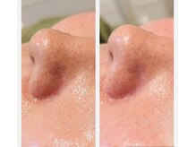 リム ビューティー(RYM BEAUTY)/毛穴ケアや毛穴引き締めにも