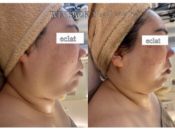 エクラ 五反田(eclat)/速攻小顔フェイシャル