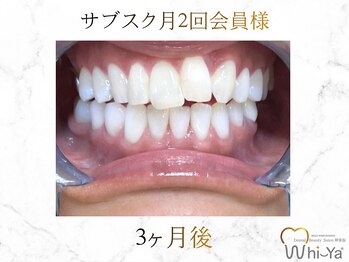 ホワイヤ セルフホワイトニング DBS神楽坂(Whi-Ya)/☆サブスク会員様☆納得の白さ☆