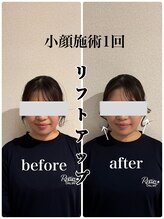 リバイブ 自由が丘店(REVIVE)/小顔矯正+ドライヘッドスパ1回
