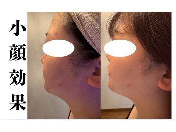 ルナ(Luna)の写真/小顔の救世主！大人気のレモンボトルフェイシャル！脂肪分解で即効即効リフトアップが叶います♪