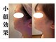ルナ(Luna)の写真/小顔の救世主！大人気のレモンボトルフェイシャル！脂肪分解で即効即効リフトアップが叶います♪