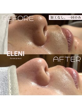エレーニ 麻布十番(ELENI)/ハイドロピーリング・毛穴洗浄