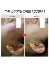 ビーフィール 府中店(be feel)/ニキビケアもご相談ください☆
