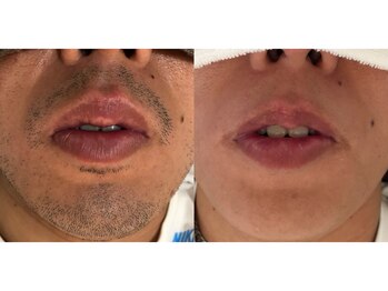 ワイスタイル(Ystyle)/20代男性　ヒゲ脱毛５回