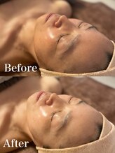 アメリ(Amelie)/ハーブピーリングBefore＆After