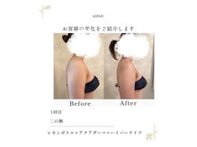 ADIMU　privatebeautysalonの雰囲気（【二の腕】ハイパーナイフ×レモンボトル痩身◎）