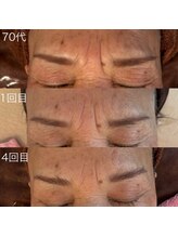 シェリモ(CHERIMO)/VOSサロンケア　ホワイト　4回