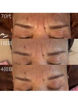 シェリモ(CHERIMO)/VOSサロンケア　ホワイト　4回