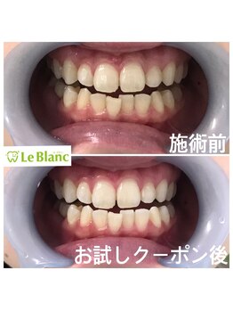 ルブラン 奈良店(Le Blanc)/whiteningは今や当たり前!