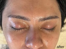 サロン ド エメ(salon de aimer)/【After】開き毛穴、くすみ改善