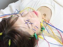 オリナ(olina)/人気NO.1美容鍼灸