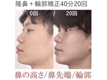 ラプリ 大阪心斎橋店(Raplit)/隆鼻＋輪郭矯正40分20回
