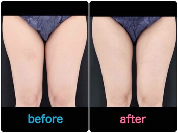 エルミューノ(elμno)/大腿部 ビフォーアフター