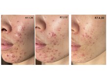 リコ(Lico)/ニキビケア3ヶ月の肌変化