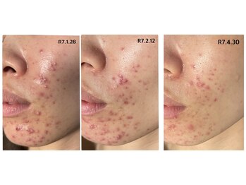 リコ(Lico)/ニキビケア3ヶ月の肌変化