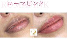 ツキ(TUKI+)/ローマピンク★全身の黒ずみ除去