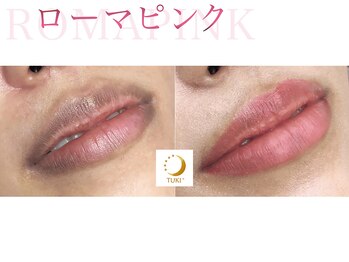 ツキ(TUKI+)/ローマピンク★全身の黒ずみ除去