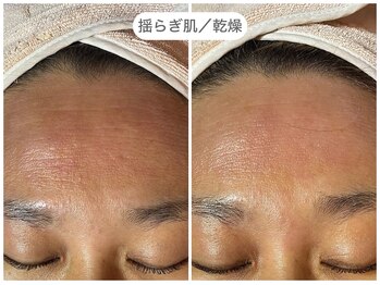 フラックス 京都(FLUX)/【ダーマロジカ】鎮静ケアコース