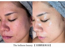 ザ ベルネス(The bellness)/【セルマン】肌改善・ピーリング