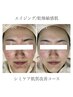 エイジング/美白/肌質改善/デコルテ込☆シミケア肌質改善コース☆初回