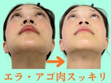 ナチュラルパーフェクトフェイス 新宿/顎の歪みを整え小顔/新宿駅小顔