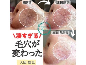 リッカロッカ(RIKKA&ROCCA)/毛穴が変わった！