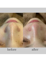 毛穴専科/一度で効果実感！
