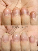 マリーロール 梅田店(Marie Laure)/自爪育成/深爪矯正/ネイルケア