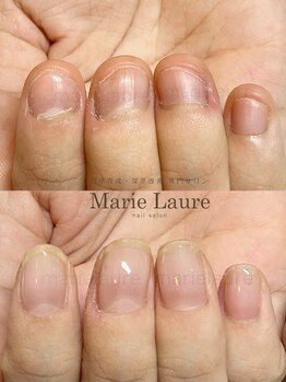 マリーロール 梅田店(Marie Laure)/自爪育成/深爪矯正/ネイルケア