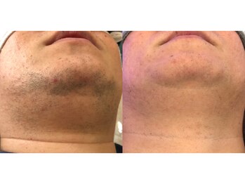 ワイスタイル(Ystyle)/40代男性　ヒゲ脱毛　３回