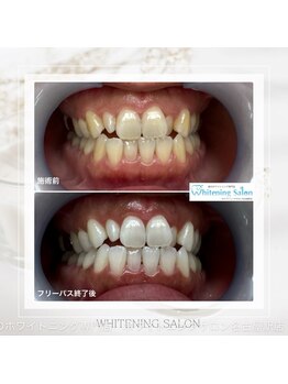 ホワイトニングサロン 名古屋駅店/【ホワイトニング施術例】