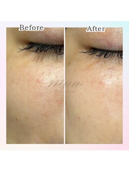 ムゥ(muu)/【毛穴洗浄】