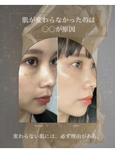 ヒュウ(hue.)/韓国発最新肌管理[セルマン]