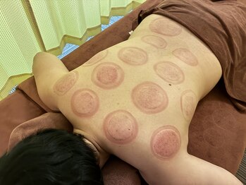 水の森/吸い玉カッピング♪