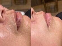 バリット 苦楽園(VALLITTO)/CSP／クリアスキンプログラム