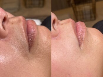 バリット 苦楽園(VALLITTO)/CSP／クリアスキンプログラム