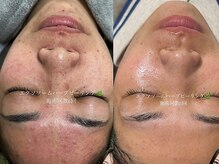 サロン アンネ(Anne)/エクソソームハーブピーリング