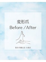 巻き爪補正店 小倉店/【変形爪】