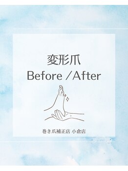 巻き爪補正店 小倉店/【変形爪】