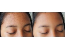 パーフェクトフェイスビューティー 梅田店(PERFECT FACE BEAUTY)/ニキビケア