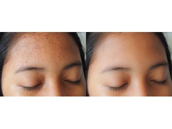 パーフェクトフェイスビューティー 梅田店(PERFECT FACE BEAUTY)/ニキビケア