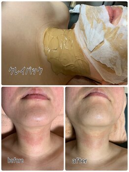 アロマ&クレイケアルーム ネロリドール(Nerolidol)/痒みにもクレイ！