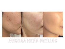 アイル 江坂店(iru)/自社製造のハーブピーリング